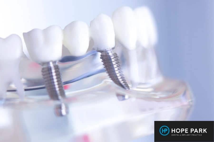 Dental Implants model